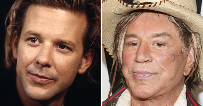 Side-by-side images of a male celebrity before and after plastic surgery, illustrating changes in appearance and skin texture.