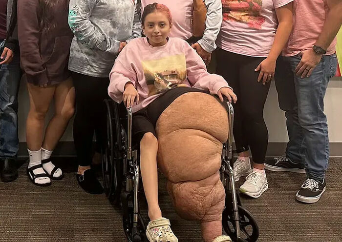 14YO girl with rare condition sitting in wheelchair showing 174lb leg affected by overgrowth before surgery.