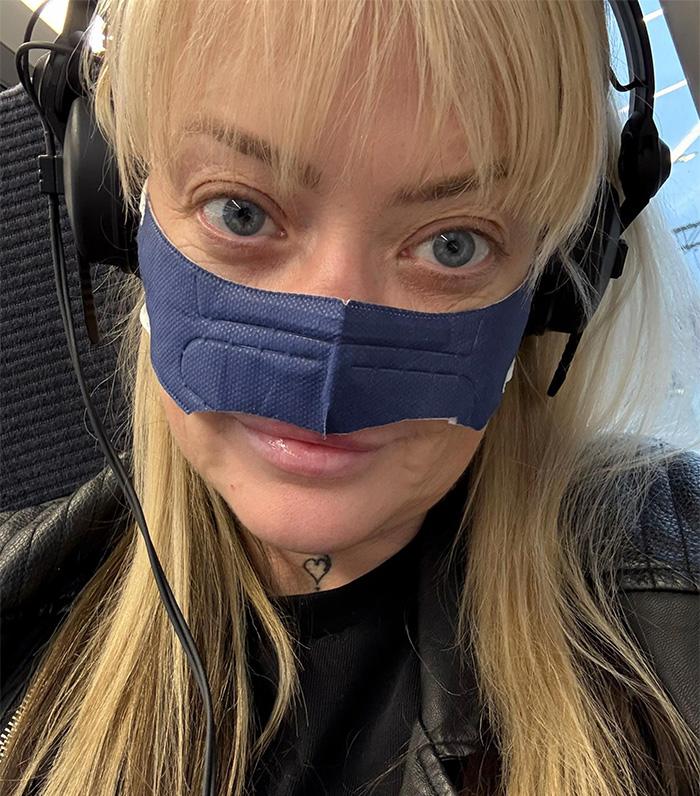 Woman wearing nose support mask and headphones, showing effects after getting veneers in Turkey. Woman wearing nose support mask and headphones, showing effects after getting veneers in Turkey.