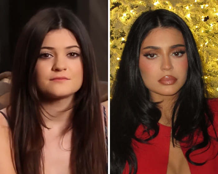 Side-by-side images of a young woman before and after plastic surgery, highlighting risks of surgery in Vietnam. Side-by-side images of a young woman before and after plastic surgery, highlighting risks of surgery in Vietnam.