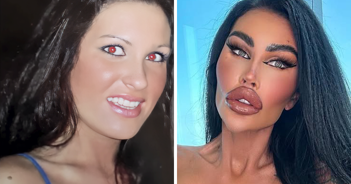 20 Famous People Who Might Have Gone Too Far With Plastic Surgery