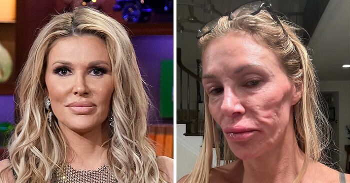 Brandi Glanville Finally Receives Diagnosis For Facial Disfigurement After Blaming A Parasite