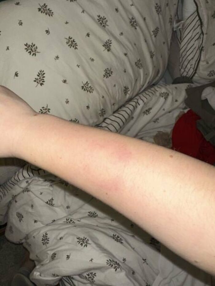 Forearm showing red marks and bruises on a bed with patterned sheets, related to Christmas nanny kid bite incident.