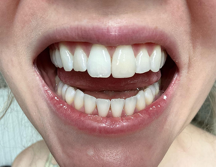 Close-up of smiling mouth with teeth, illustrating habits affecting mental and physical health long-term.