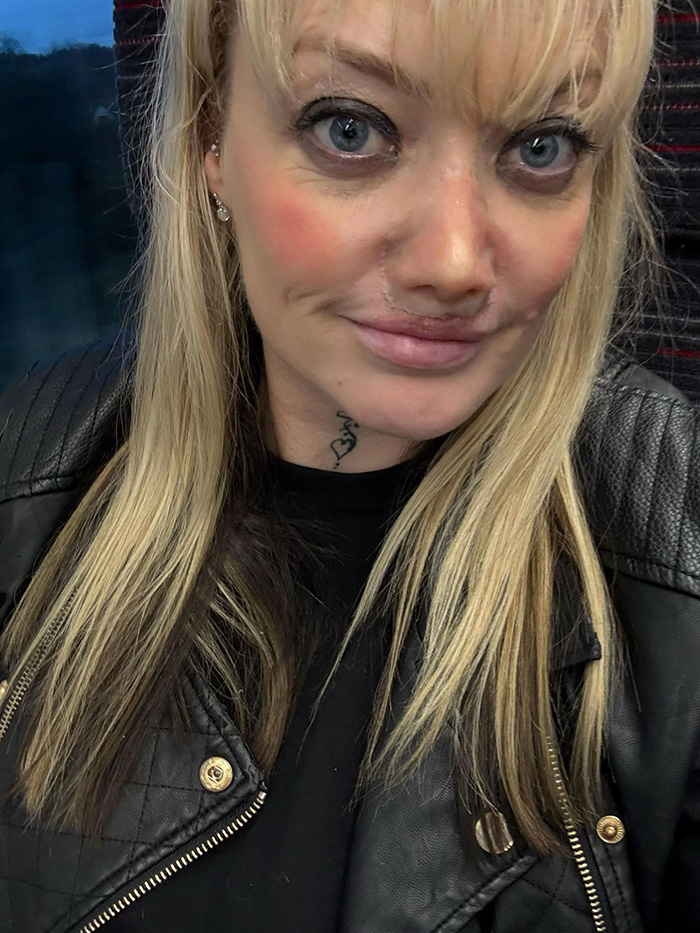 Close-up of a woman with a collapsed nose, showing facial scars and wearing a black leather jacket and blonde hair. Close-up of a woman with a collapsed nose, showing facial scars and wearing a black leather jacket and blonde hair.