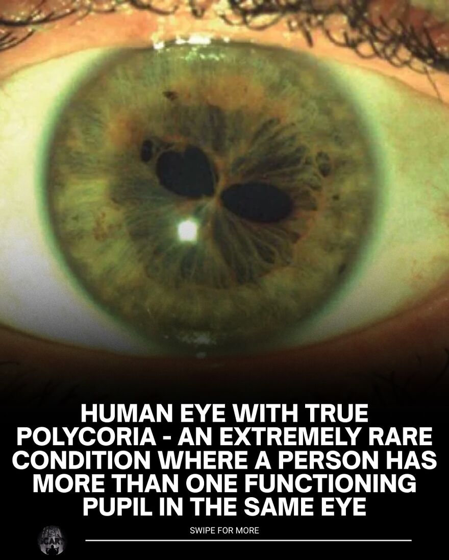 Close-up of a human eye showing polycoria, a rare condition with multiple functioning pupils, highlighting scary bone facts theme.