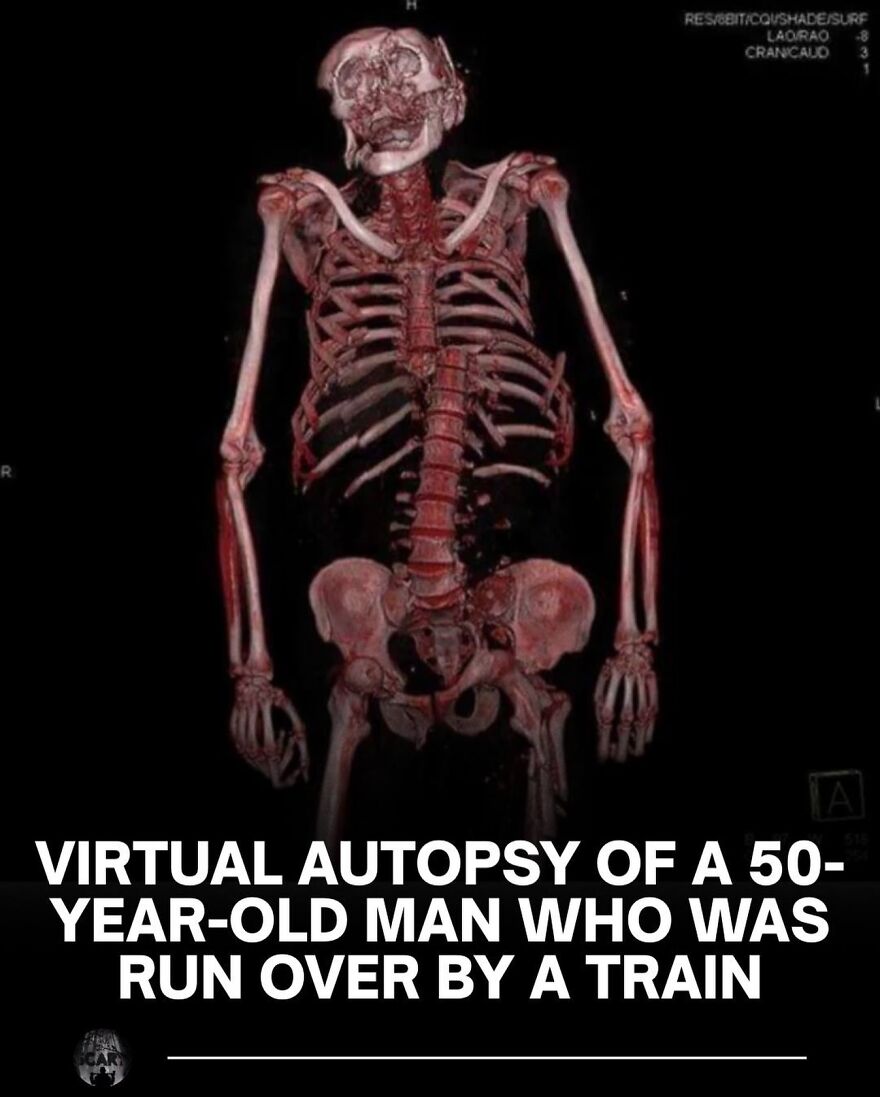 3D scan showing a virtual autopsy skeleton with bones and tissues, illustrating scary bone facts for sleep loss readers.