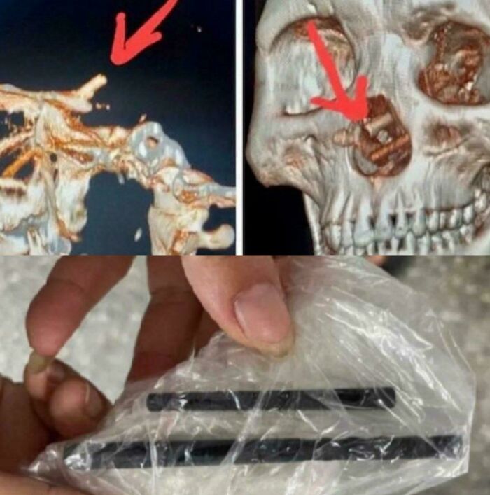 CT scans showing a metal object lodged near the skull and a hand holding similar metal pieces in plastic wrap, interesting but creepy photos.