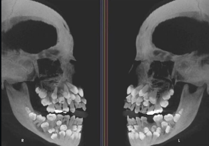 X-ray image showing an unusual dental condition with multiple teeth, highlighting interesting but creepy medical photos.