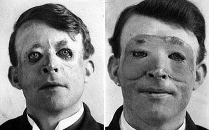 Side-by-side old black and white portraits featuring an odd and creepy man with facial deformities and unusual features.