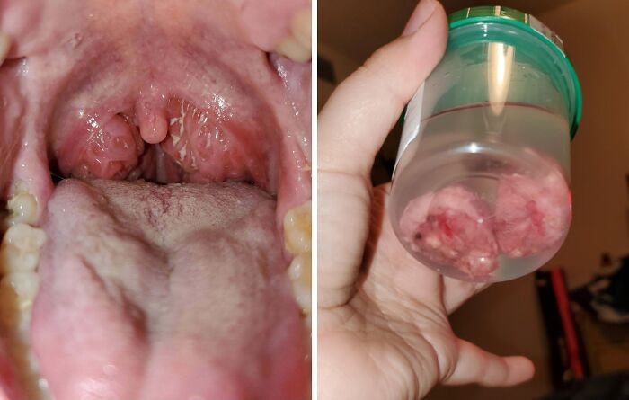 Close up of inflamed tonsils and removed tonsil tissue in a specimen jar, medical pics showing post-tonsillectomy