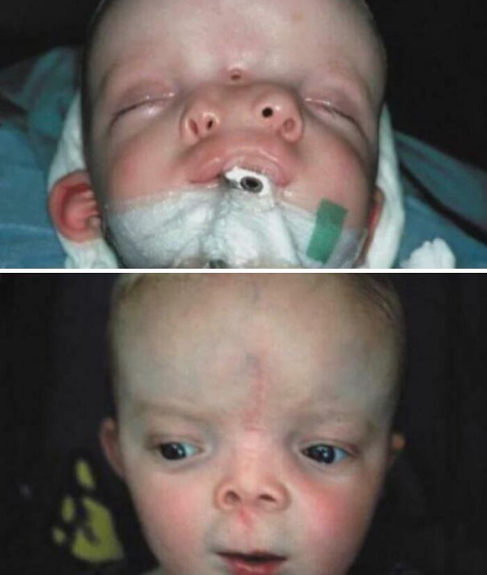 Infant with throat tube and facial scar in before and after view, medical pics