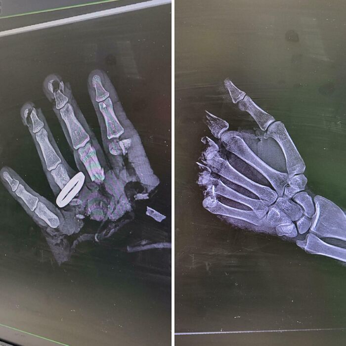 Two-panel X-ray showing a severely fractured, mangled hand with bone fragments and a ring present, medical pics
