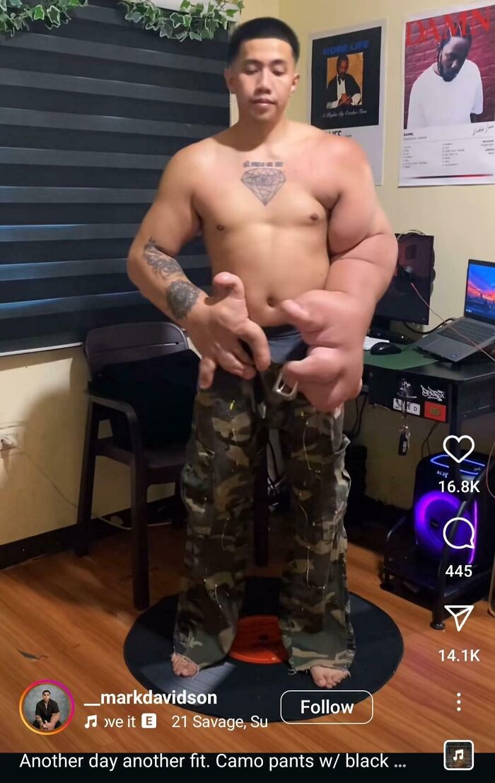 Shirtless man with massively swollen right arm and hand standing in a room wearing camo pants, medical pics