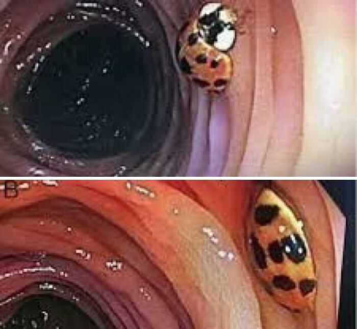 During A Colonoscopy Performed On A 59-Year-Old Man, An Unexpected Guest Was Found In His Intestine