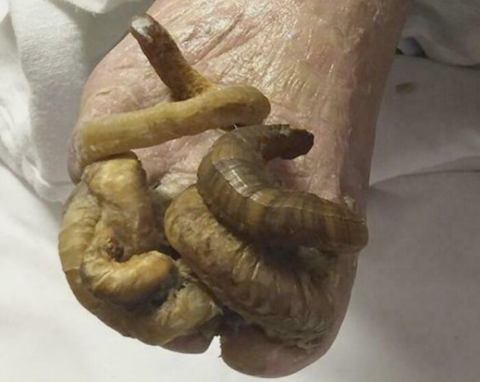Elderly foot with severely thick, curled yellow toenails resembling coils, medical pics