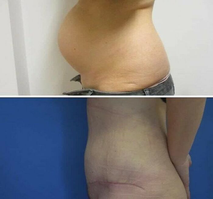 Imagen médica que muestra abdomen antes y después, ejemplo de fotos médicas extrañas y fascinantes.