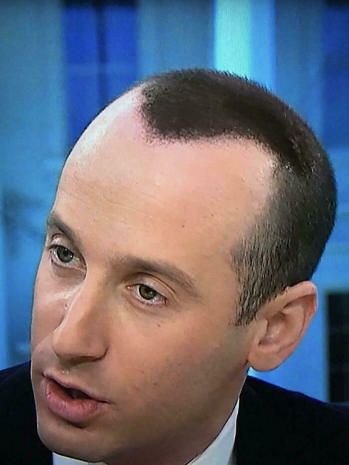 A man with a receding hairline and an unfortunate haircut, where only a small section of hair remains.