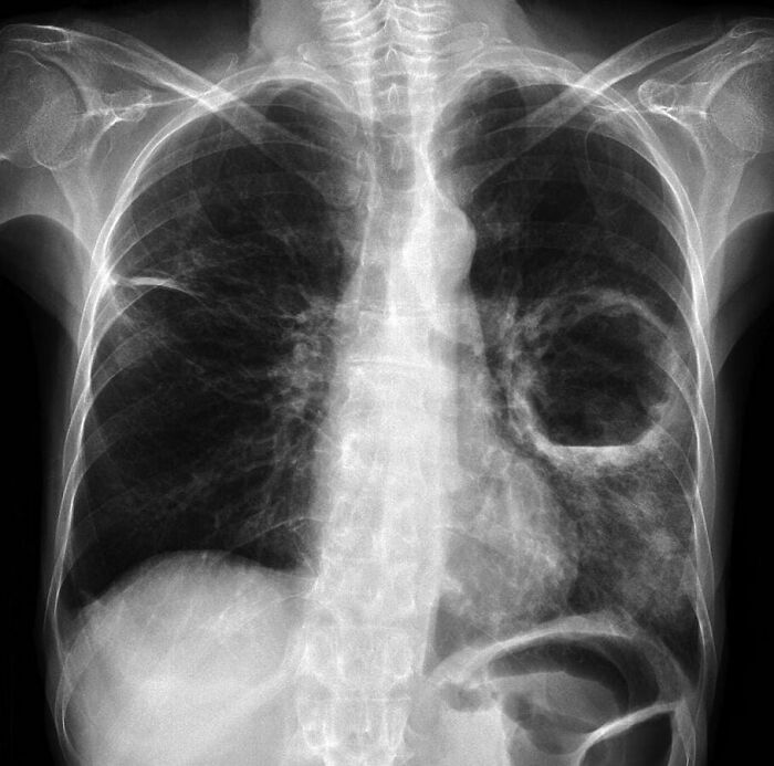 X-ray image showing an abnormal lung cavity highlighting a fascinating and unnerving medical condition to process.