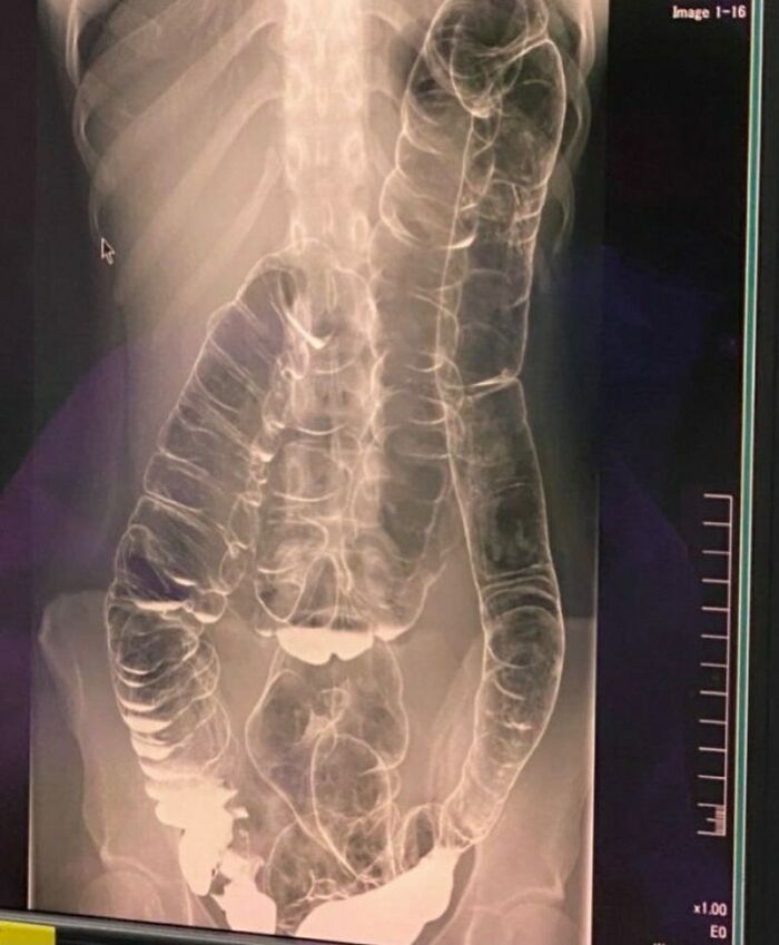 X-ray showing an unnerving medical image of the human digestive tract with detailed intestinal structure visible.