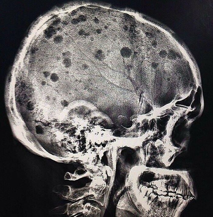 X-ray of a human skull showing unusual dark spots, one of many fascinating and unnerving medical pics to process.