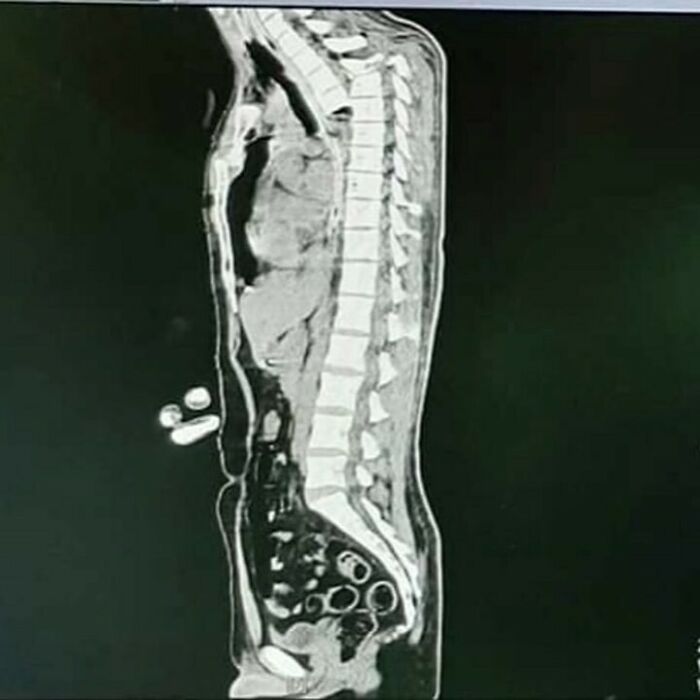 MRI scan showing an unnerving medical image of a human spine and surrounding organs in a side view.