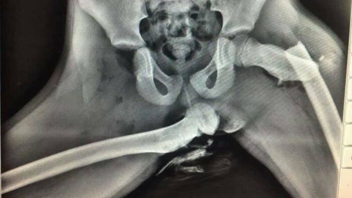 Radiografía médica mostrando una fractura de cadera extraña y ligeramente perturbadora con huesos desplazados y muy detallada.