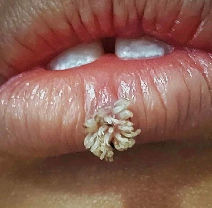 Primer plano de lesión médica extraña y ligeramente inquietante en el labio, imagen médica que resulta hipnótica y perturbadora.