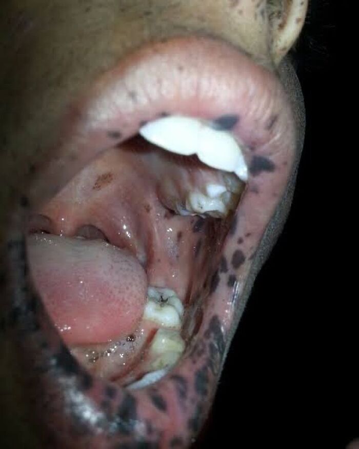 Close-up of a mouth showing unusual dark spots on the lips and inside, a fascinating and unnerving medical pic.