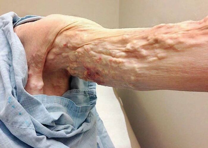 Close-up of an arm with unnerving varicose veins and skin irregularities in a medical setting, showcasing medical pics.