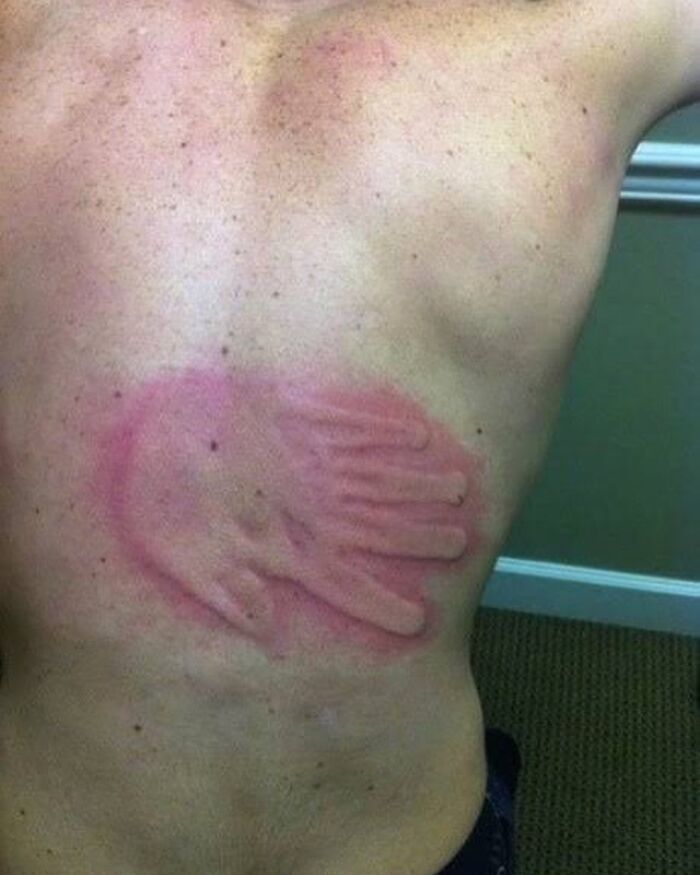 Red handprint-shaped bruise on a person's back, an unnerving medical pic showing skin reaction from pressure or injury.