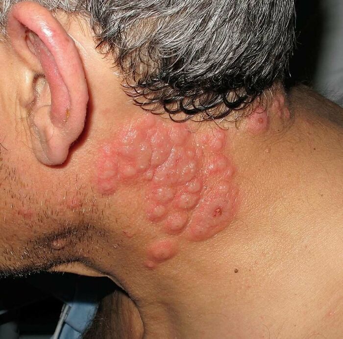 Erupción médica inusual y ligeramente inquietante en el cuello de un paciente con piel inflamada y ampollas.