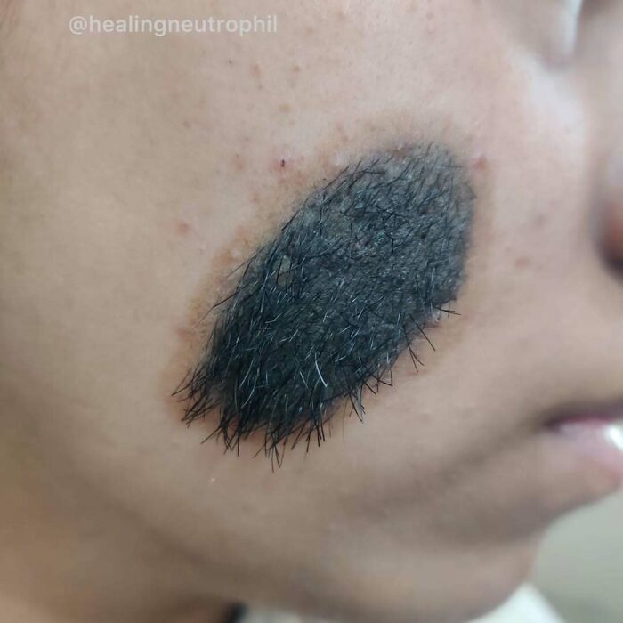 Primer plano de una mancha médica inusual y ligeramente perturbadora en la cara con crecimiento de cabello denso.