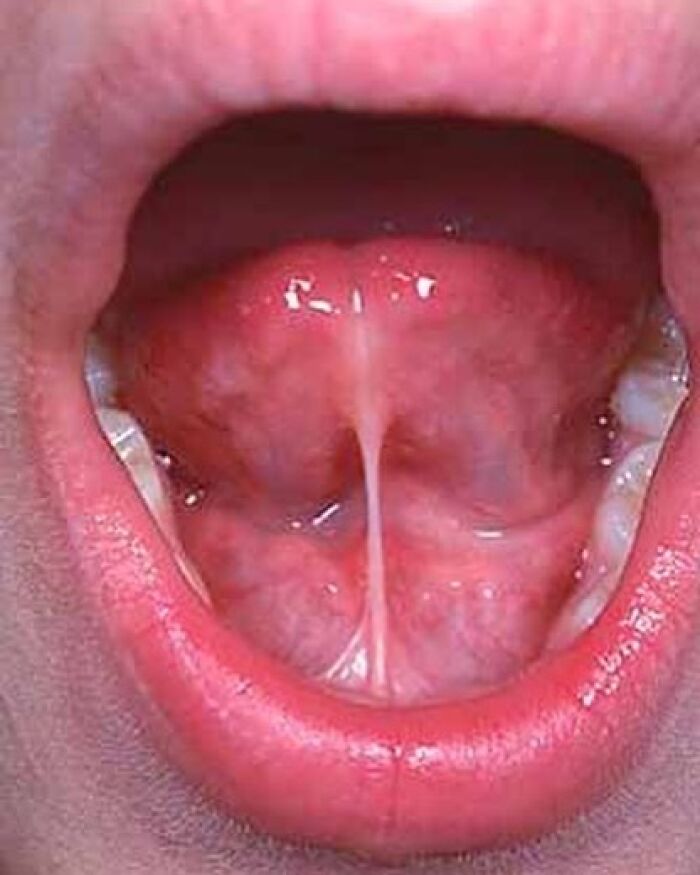 Primer plano de la boca abierta mostrando un frenillo lingual bajo la lengua, imagen médica ligeramente perturbadora y fascinante.