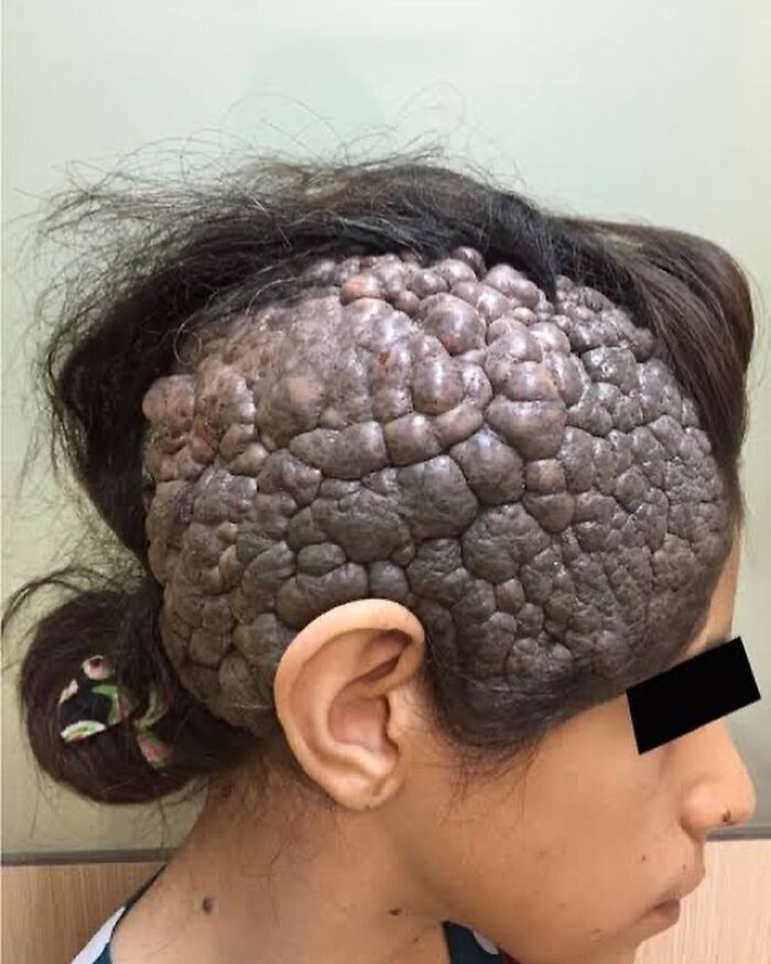 Close-up of a person’s scalp with large, unnerving skin growths featured in fascinating medical pics.