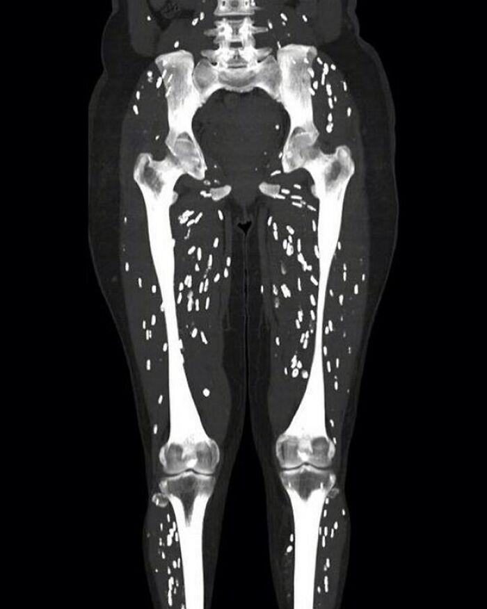 CT scan of legs showing numerous small metal fragments embedded in the tissue, a fascinating and unnerving medical pic.