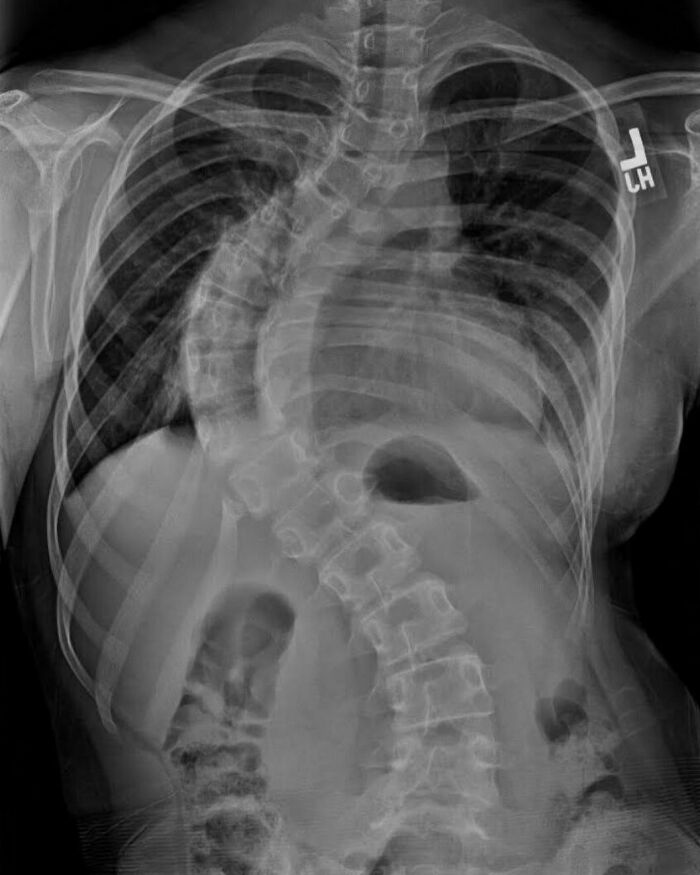 Radiografía médica del torso que muestra una curvatura espinal inusual en una imagen médica extraña y cautivadora.