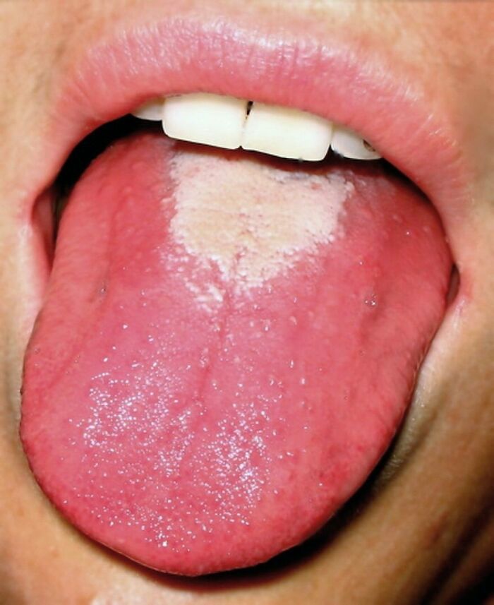 Close-up of a tongue showing a white patch, an unnerving medical condition seen in fascinating medical pics.
