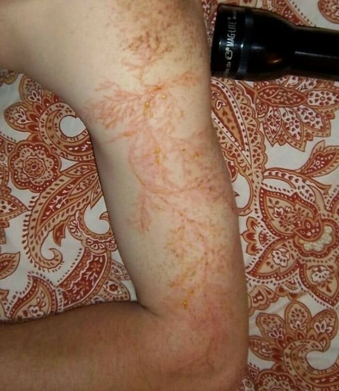 Close-up of an arm showing unusual vein patterns resembling plant shapes in a fascinating medical pic.