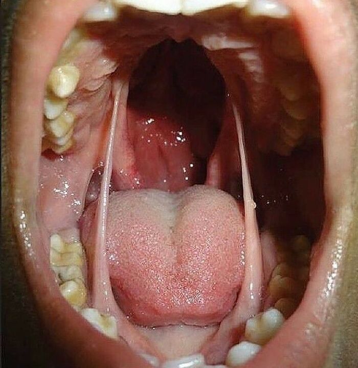 Close-up medical pic showing an open mouth with a bifid tongue and visible teeth and throat details.