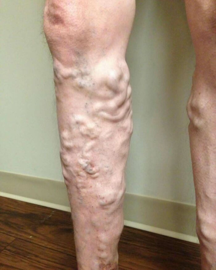 Pierna con venas varicosas visibles, imagen médica inquietante y ligeramente hipnótica de condición vascular.