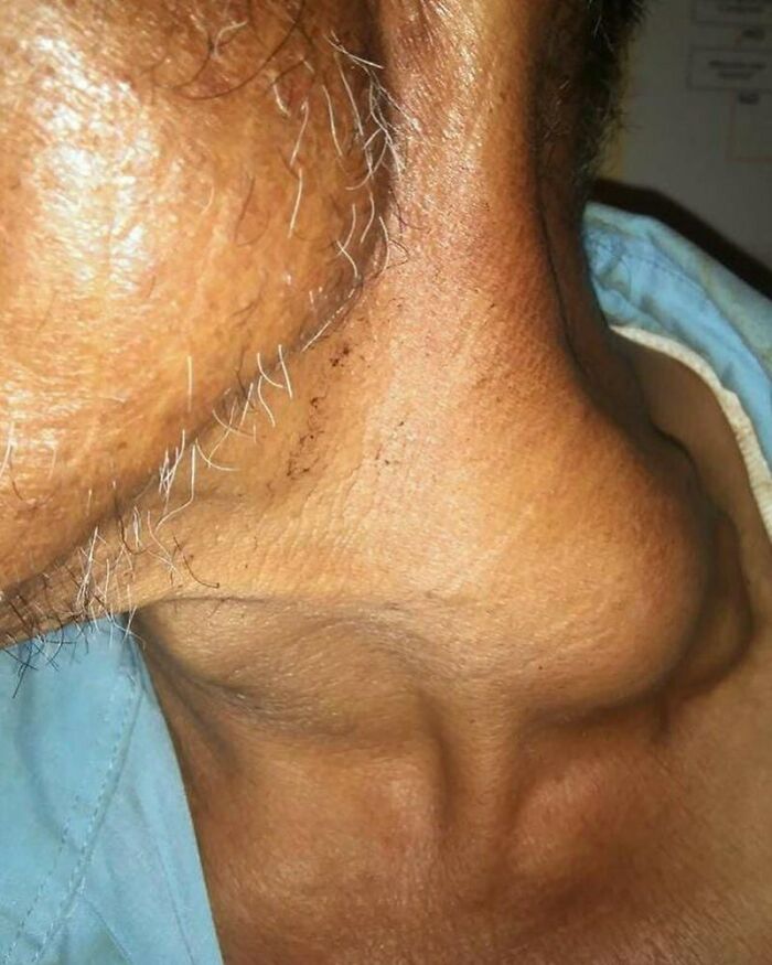 Enlarged neck mass visible on the side of an elderly person's skin, a disturbing medical anomaly photo.