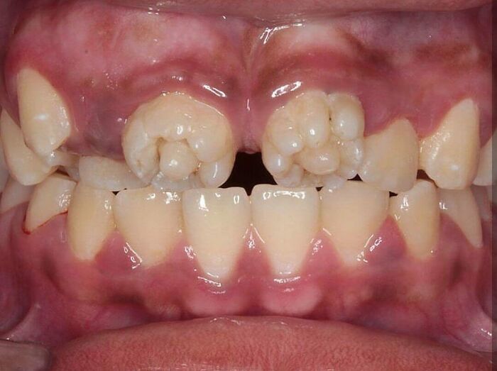 Close-up of unusual dental formation showing malformed teeth and gums in a fascinating and unnerving medical pic.
