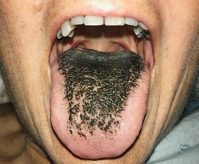 Close-up of a tongue with black discoloration illustrating a fascinating and unnerving medical condition.