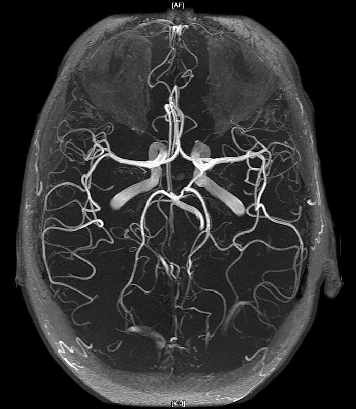 MRI brain scan showing detailed blood vessels in a fascinating and unnerving medical image.