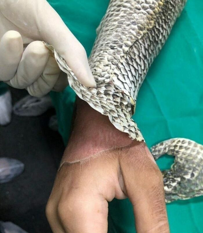 Hand with snake skin peeling off, illustrating a fascinating and unnerving medical image showing skin shedding.