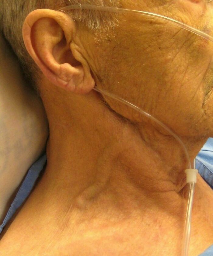 Close-up of an elderly patient’s neck and face with an oxygen tube, showing medical details in a clinical setting.