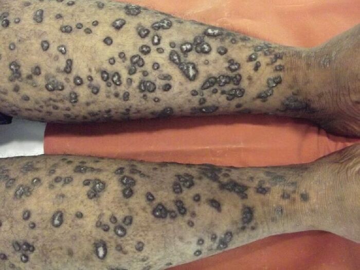 Legs covered in numerous dark, raised medical lesions showing a fascinating and unnerving medical condition.