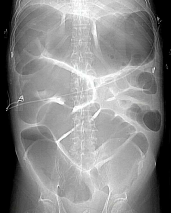 X-ray showing complex intestinal obstruction with medical tubing, a fascinating and unnerving medical pic to process.