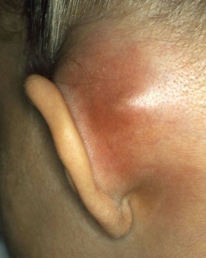 Close-up of a swollen, red area near the ear showing an unnerving medical condition from fascinating medical pics.
